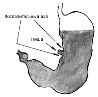 Симптом «ниши» при язве желудка, выявляемый при тугом наполнении органа. Схема Симптом «ниши» при язве желудка, выявляемый при тугом наполнении органа. Схема