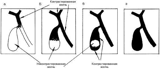 Внутривенная холеграфия: схема последовательного заполнения желчных протоков и желчного пузыря контрастным веществом (а, б, в, г). Внутривенная холеграфия: схема последовательного заполнения желчных протоков и желчного пузыря контрастным веществом (а, б, в, г).