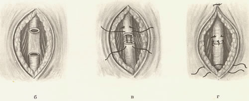 244. Операция Мариона—Хольцова. 244. Операция Мариона—Хольцова.