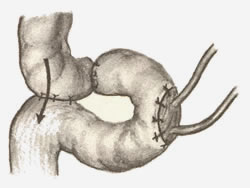 173. Операция Берглюнда—Борелиуса—Мыша. 173. Операция Берглюнда—Борелиуса—Мыша.