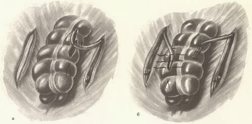 131. Операция Н. В. Маркова. 131. Операция Н. В. Маркова.